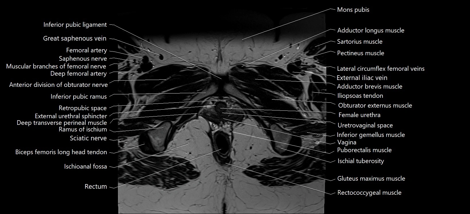 Axial cross sectional anatomy of female pelvis (MRI 3T) image 38.webp